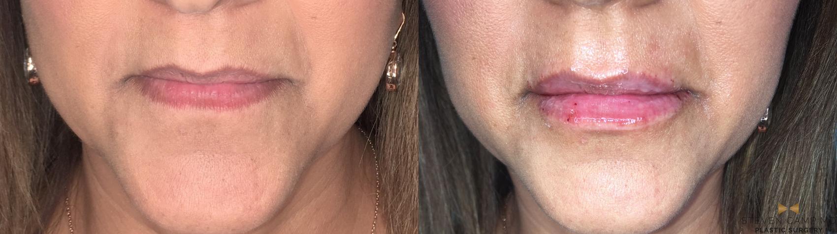 Before & After Dermal Fillers Case 368 Front View in Fort Worth, Texas