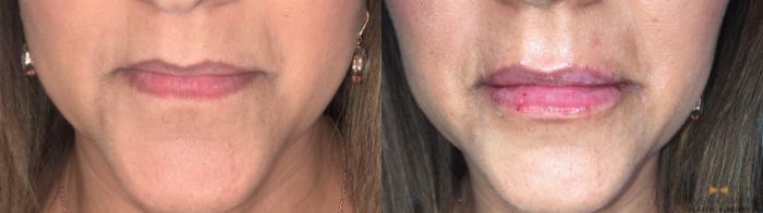 Before & After Dermal Fillers Case 368 Front View in Fort Worth, Texas