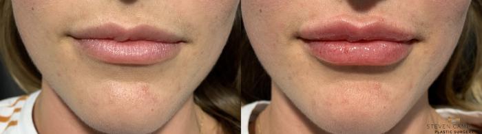 Before & After Dermal Fillers Case 369 Front View in Fort Worth & Arlington, Texas