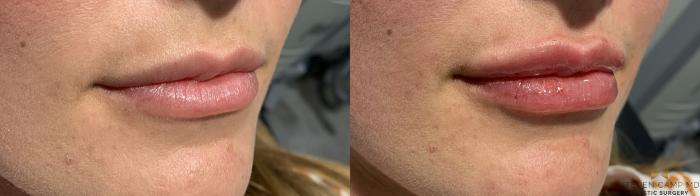 Before & After Dermal Fillers Case 369 Right Oblique View in Fort Worth, Texas
