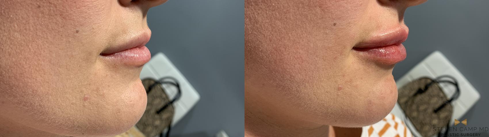 Before & After Dermal Fillers Case 369 Right Side View in Fort Worth & Arlington, Texas