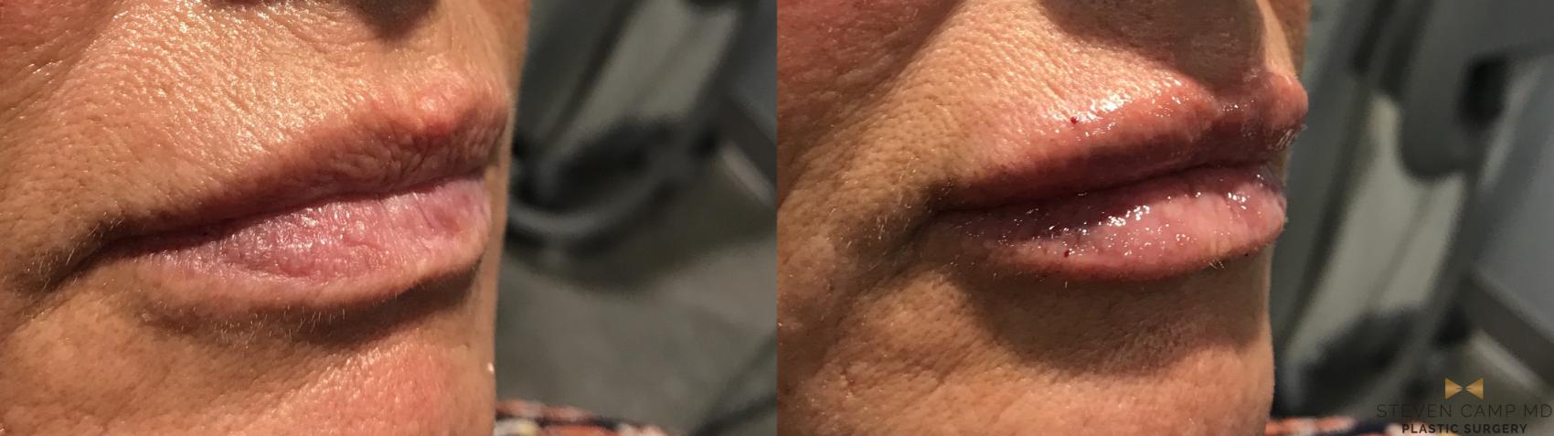 Before & After Dermal Fillers Case 370 Right Oblique View in Fort Worth & Arlington, Texas