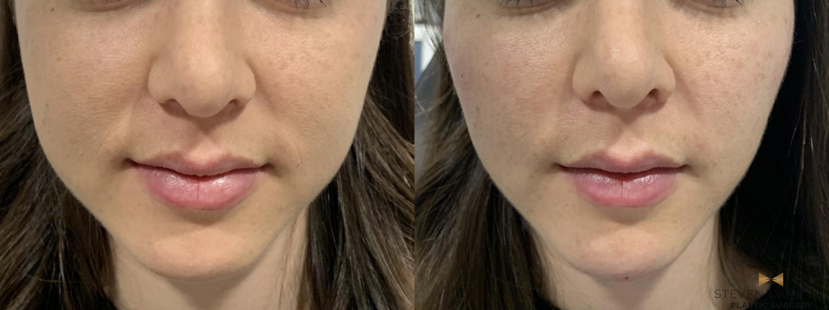 Before & After Dermal Fillers Case 371 Front View in Fort Worth & Arlington, Texas