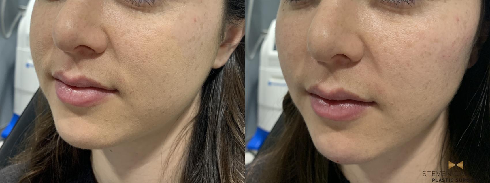 Before & After Dermal Fillers Case 371 Left Oblique View in Fort Worth & Arlington, Texas