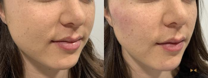 Before & After Dermal Fillers Case 371 Right Oblique View in Fort Worth & Arlington, Texas