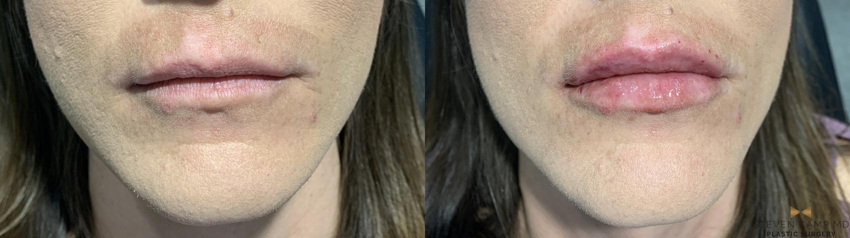 Before & After Dermal Fillers Case 373 Front View in Fort Worth, Texas