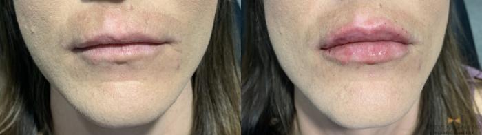 Before & After Dermal Fillers Case 373 Front View in Fort Worth, Texas