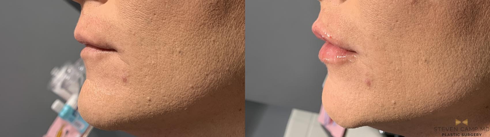 Before & After Dermal Fillers Case 373 Left Side View in Fort Worth & Arlington, Texas