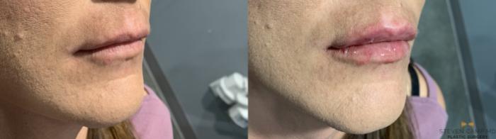 Before & After Dermal Fillers Case 373 Right Oblique View in Fort Worth & Arlington, Texas