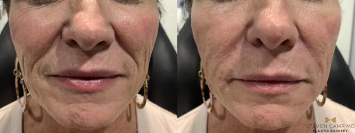 Before & After Dermal Fillers Case 390 Front View in Fort Worth & Arlington, Texas