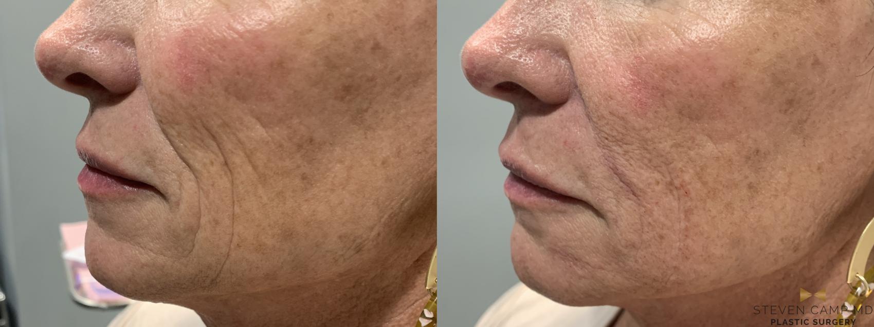Before & After Dermal Fillers Case 390 Left Side View in Fort Worth & Arlington, Texas