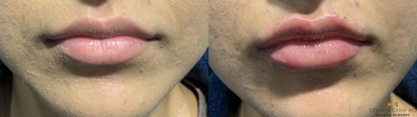 Before & After Dermal Fillers Case 392 Front View in Fort Worth & Arlington, Texas