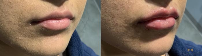 Before & After Dermal Fillers Case 392 Right Oblique View in Fort Worth & Arlington, Texas