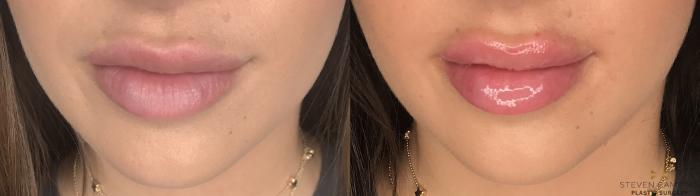 Before & After Dermal Fillers Case 393 Front View in Fort Worth & Arlington, Texas