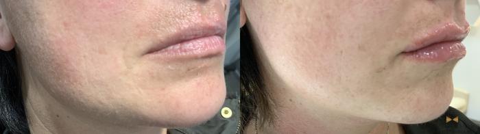 Before & After Dermal Fillers Case 396 Right Oblique View in Fort Worth & Arlington, Texas