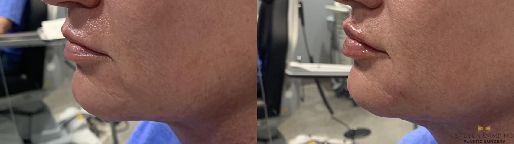 Before & After Dermal Fillers Case 397 Left Side View in Fort Worth & Arlington, Texas