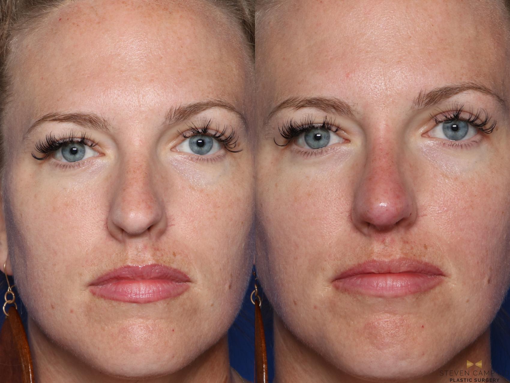 Before & After Dermal Fillers Case 418 Front View in Fort Worth, Texas