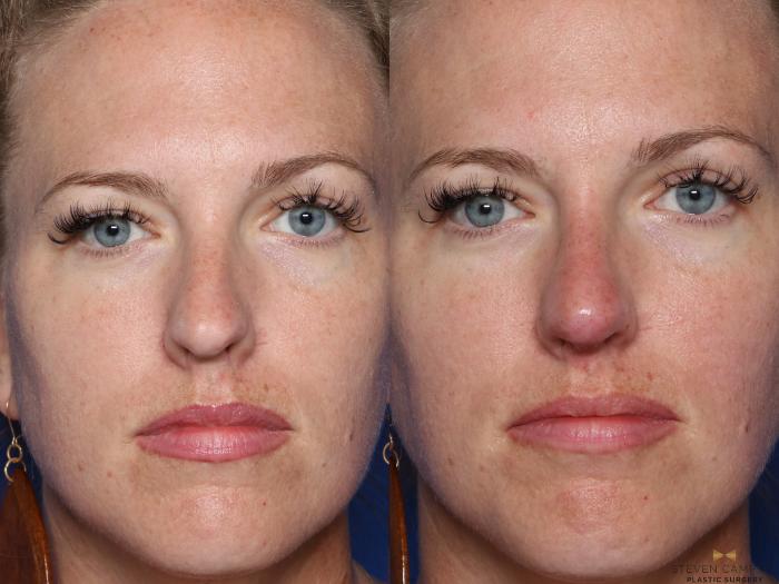 Before & After Dermal Fillers Case 418 Front View in Fort Worth, Texas