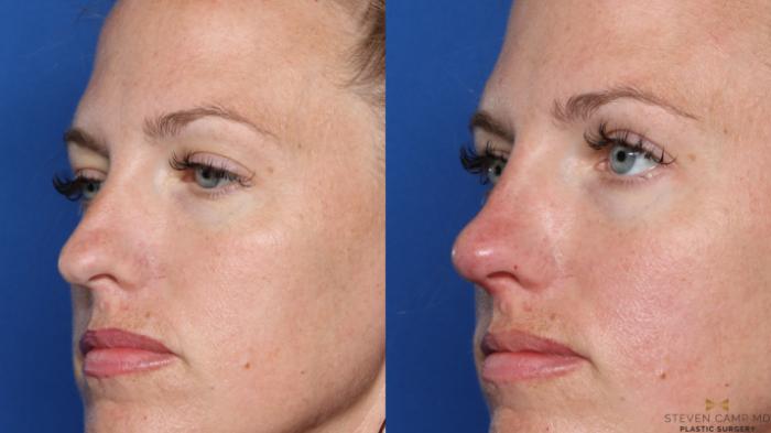 Before & After Dermal Fillers Case 418 Left Oblique View in Fort Worth, Texas