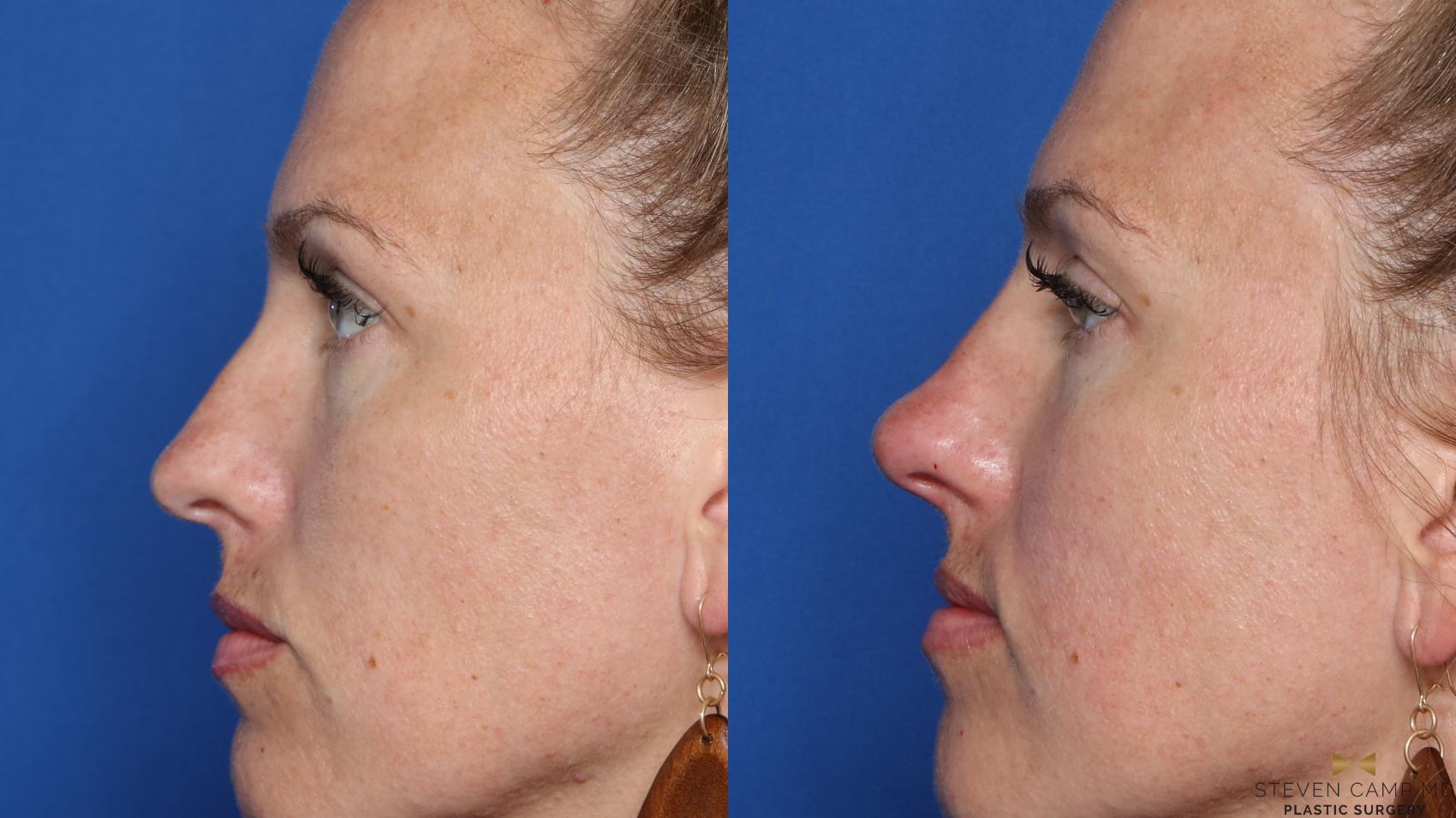 Before & After Dermal Fillers Case 418 Left Side View in Fort Worth, Texas