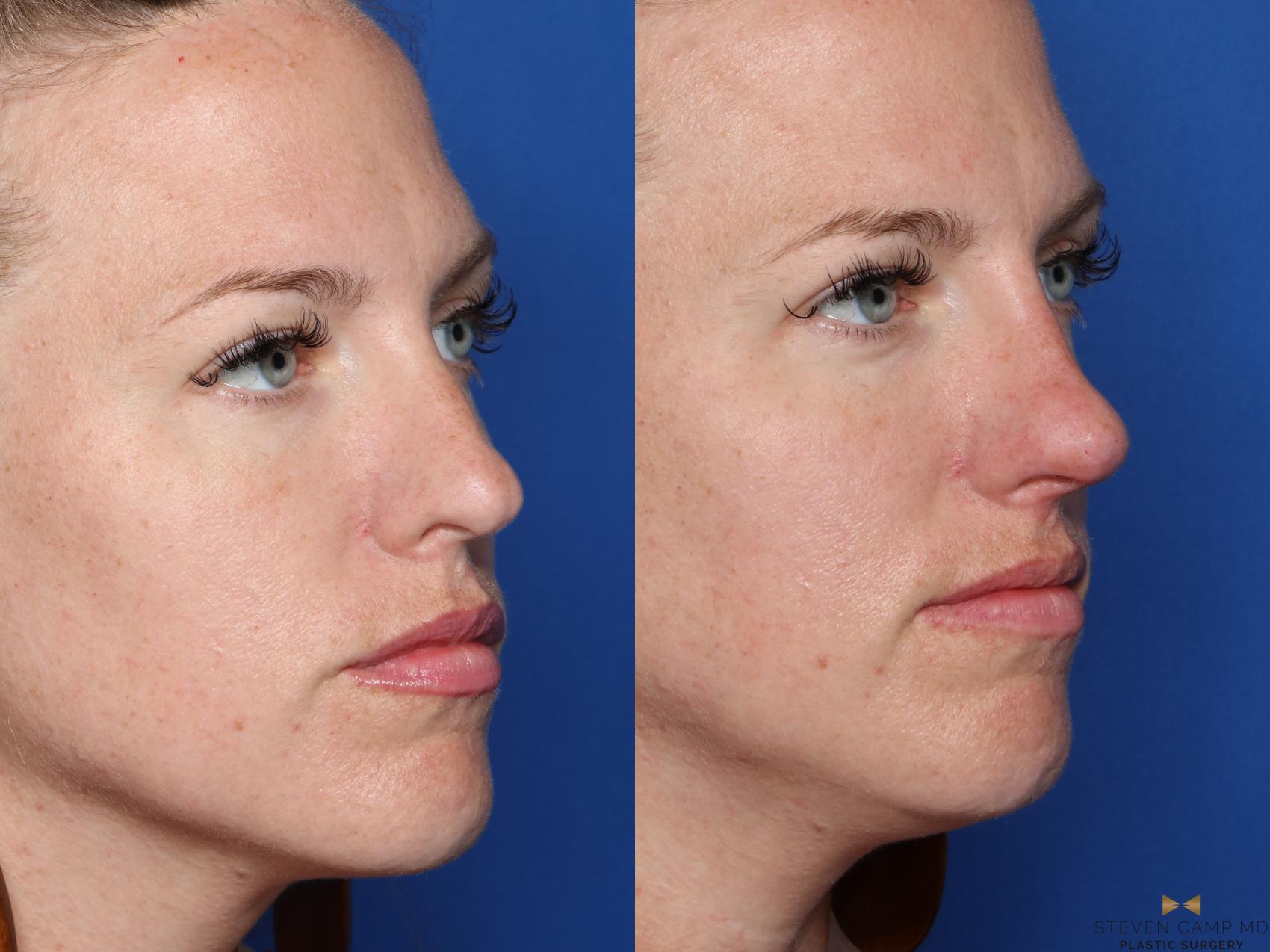 Before & After Dermal Fillers Case 418 Right Oblique View in Fort Worth, Texas