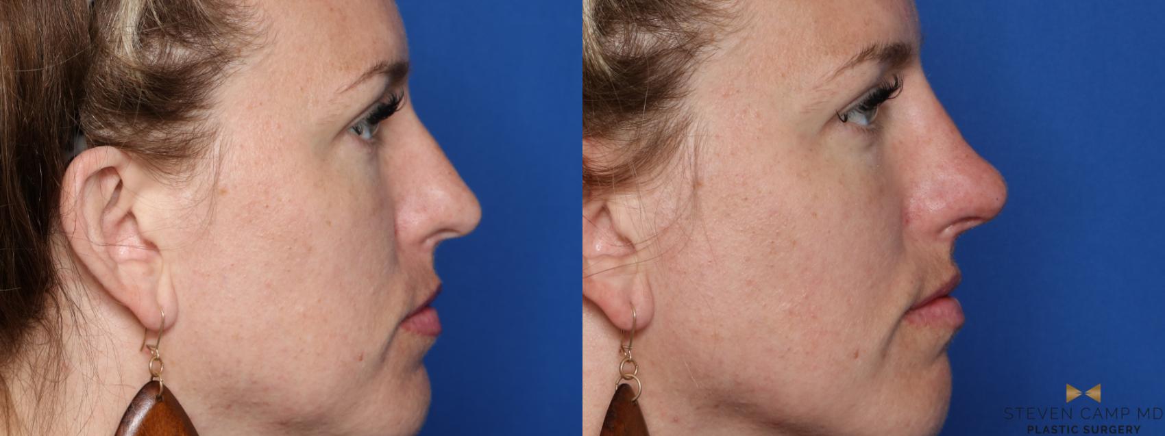 Before & After Dermal Fillers Case 418 Right Side View in Fort Worth, Texas