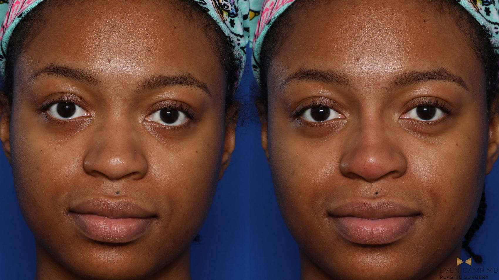 Before & After Dermal Fillers Case 419 Left Side View in Fort Worth, Texas