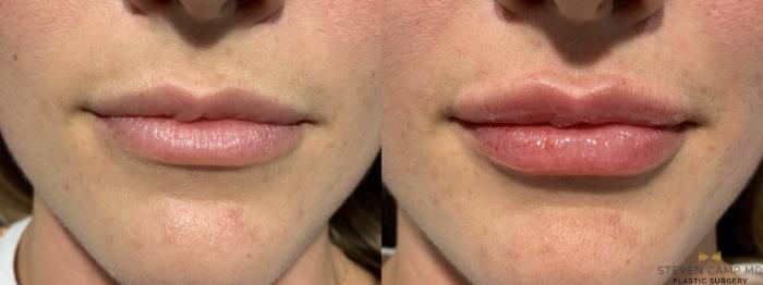 Before & After Dermal Fillers Case 466 Front View in Fort Worth & Arlington, Texas