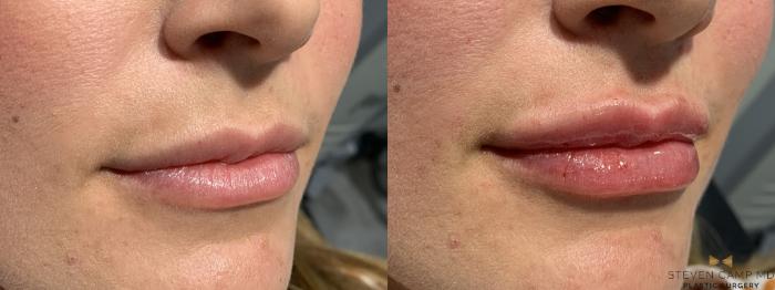 Before & After Dermal Fillers Case 466 Right Oblique View in Fort Worth, Texas