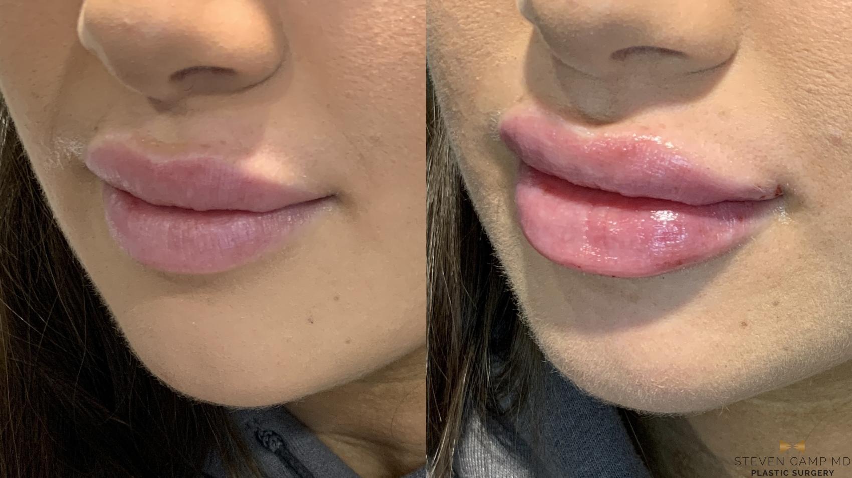 Before & After Dermal Fillers Case 467 Left Oblique View in Fort Worth, Texas