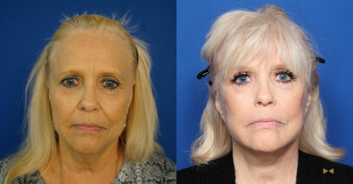 Before & After Blepharoplasty Case 335 Front View in Fort Worth & Arlington, Texas
