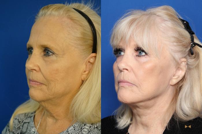 Before & After Facelift Case 335 Left Oblique View in Fort Worth & Arlington, Texas