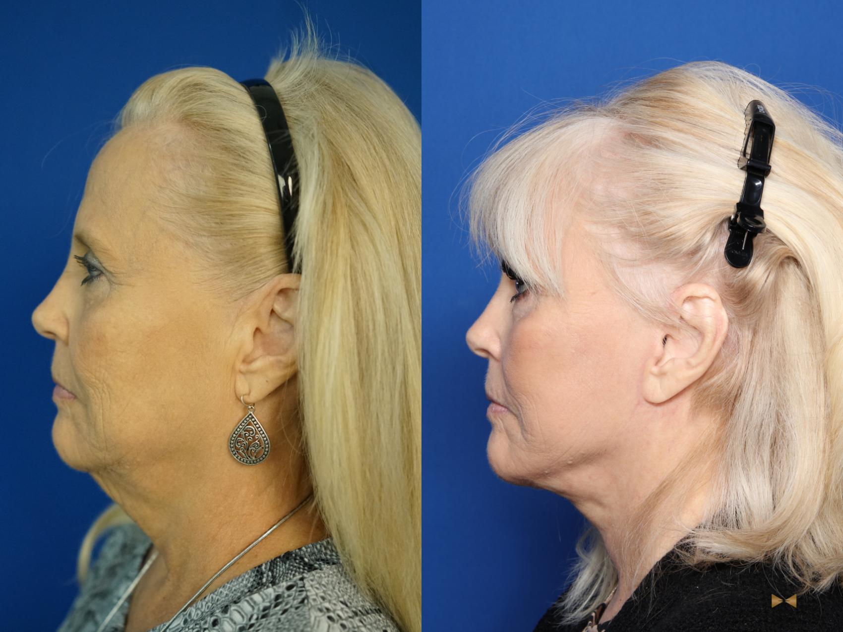 Before & After Blepharoplasty Case 335 Left Side View in Fort Worth & Arlington, Texas