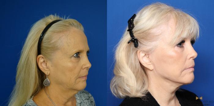 Before & After Blepharoplasty Case 335 Right Oblique View in Fort Worth & Arlington, Texas