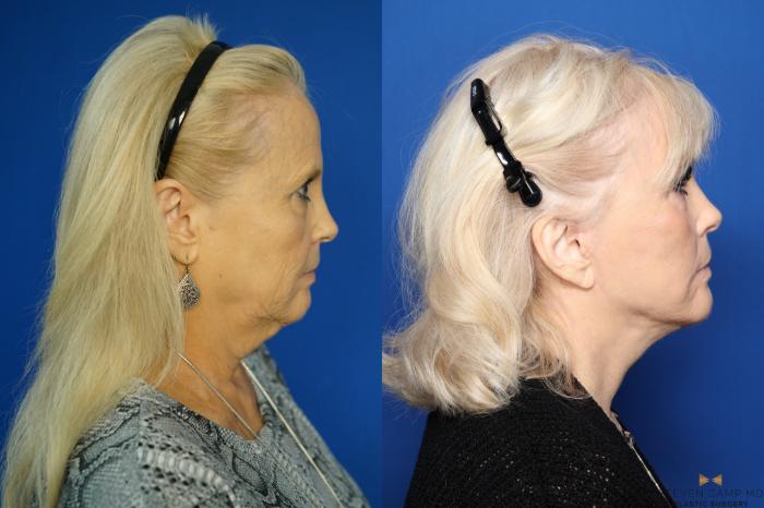 Before & After Facelift Case 335 Right Side View in Fort Worth & Arlington, Texas