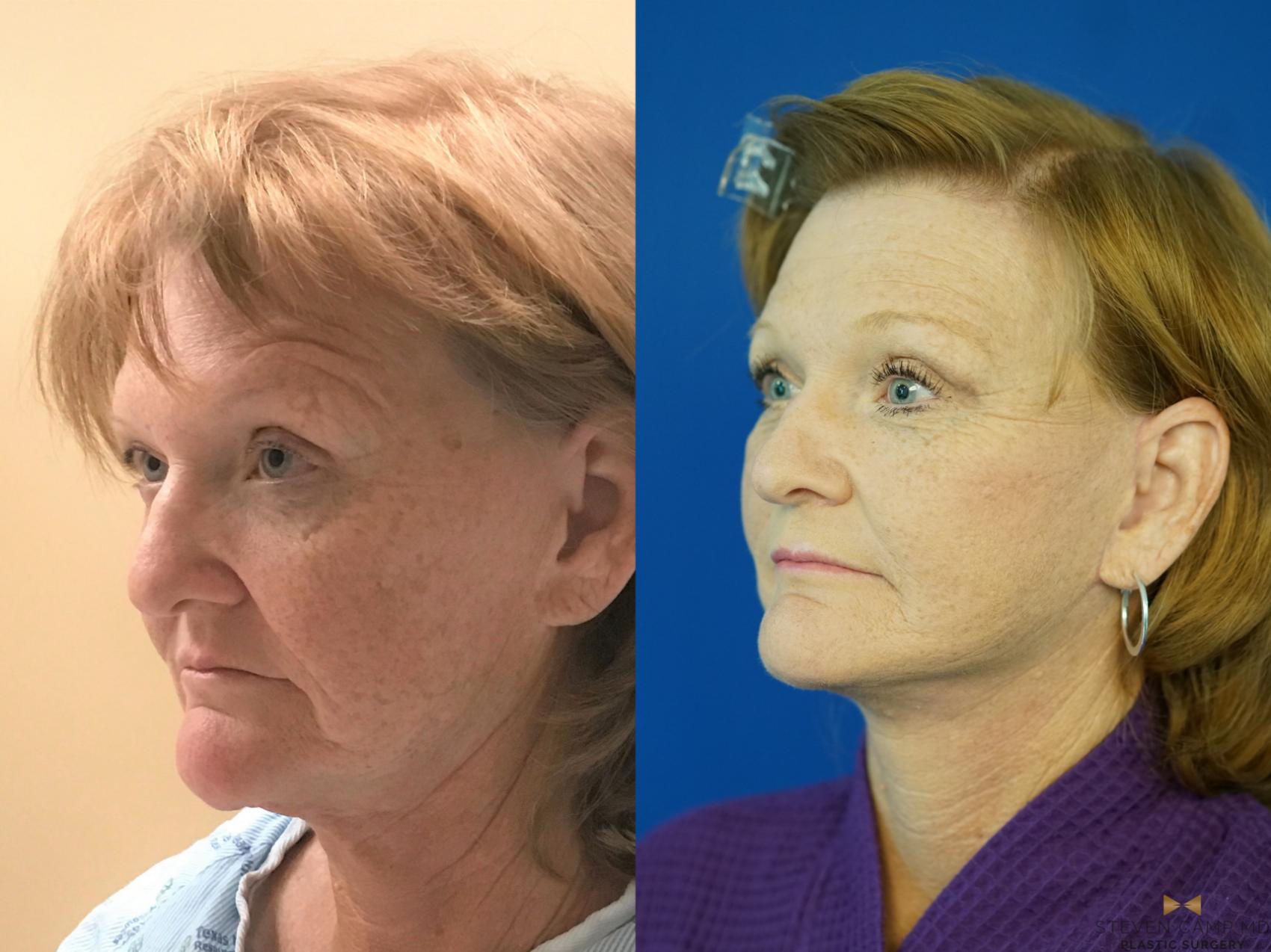 Before & After Facelift Case 338 Left Oblique View in Fort Worth, Texas