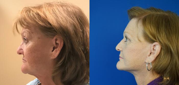 Before & After Facelift Case 338 Left Side View in Fort Worth & Arlington, Texas