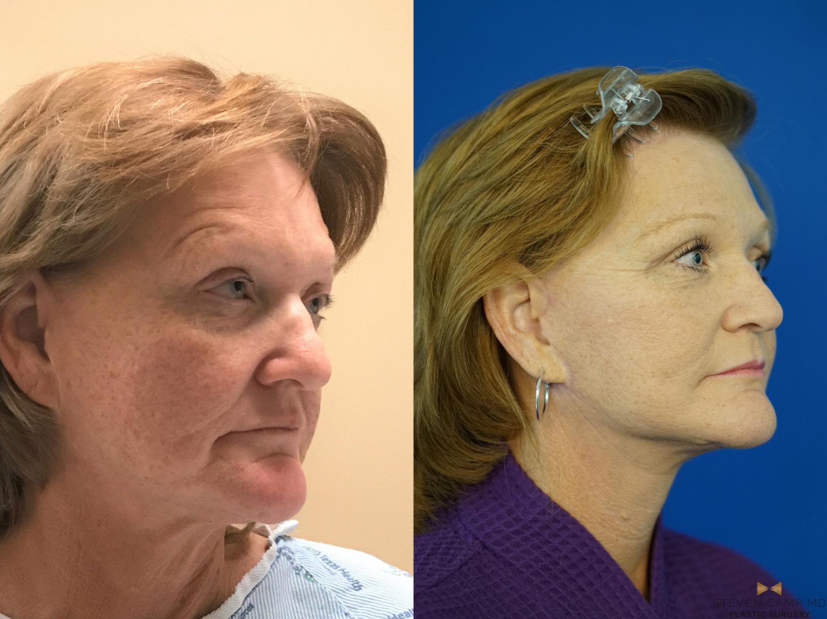 Before & After Facelift Case 338 Right Side View in Fort Worth, Texas