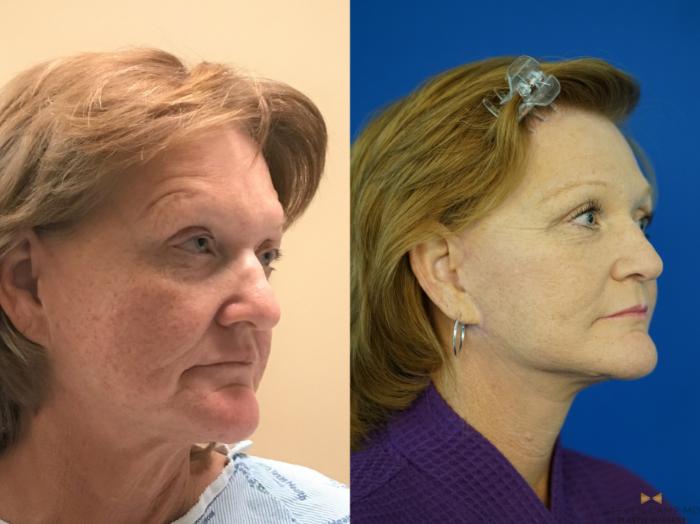 Before & After Facelift Case 338 Right Side View in Fort Worth & Arlington, Texas