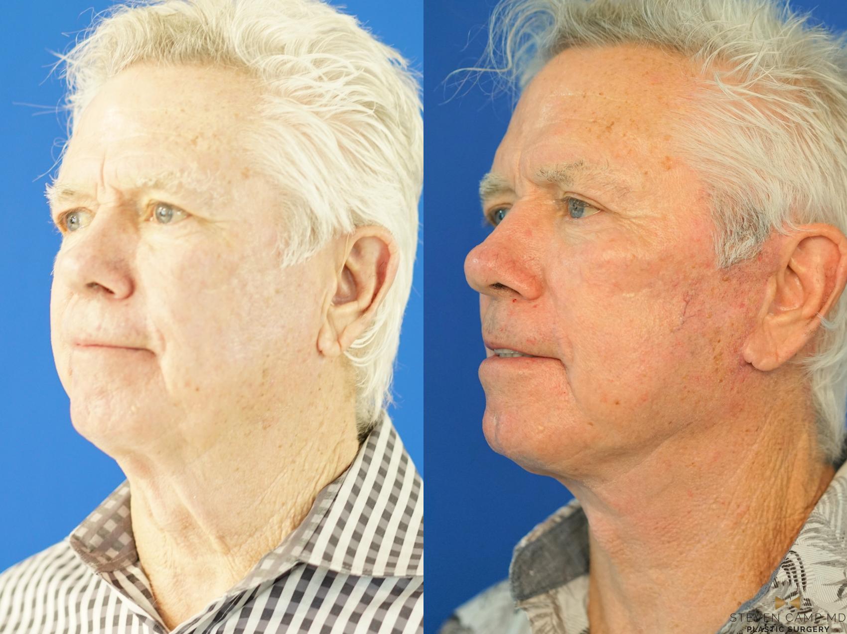 Before & After Facelift Case 339 Left Oblique View in Fort Worth, Texas