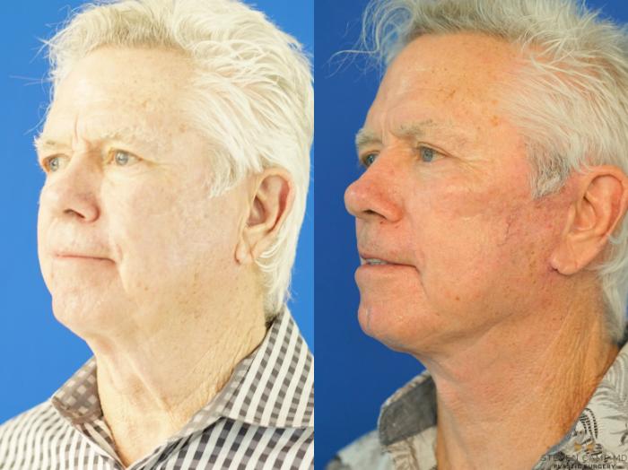 Before & After Necklift Case 339 Left Oblique View in Fort Worth & Arlington, Texas