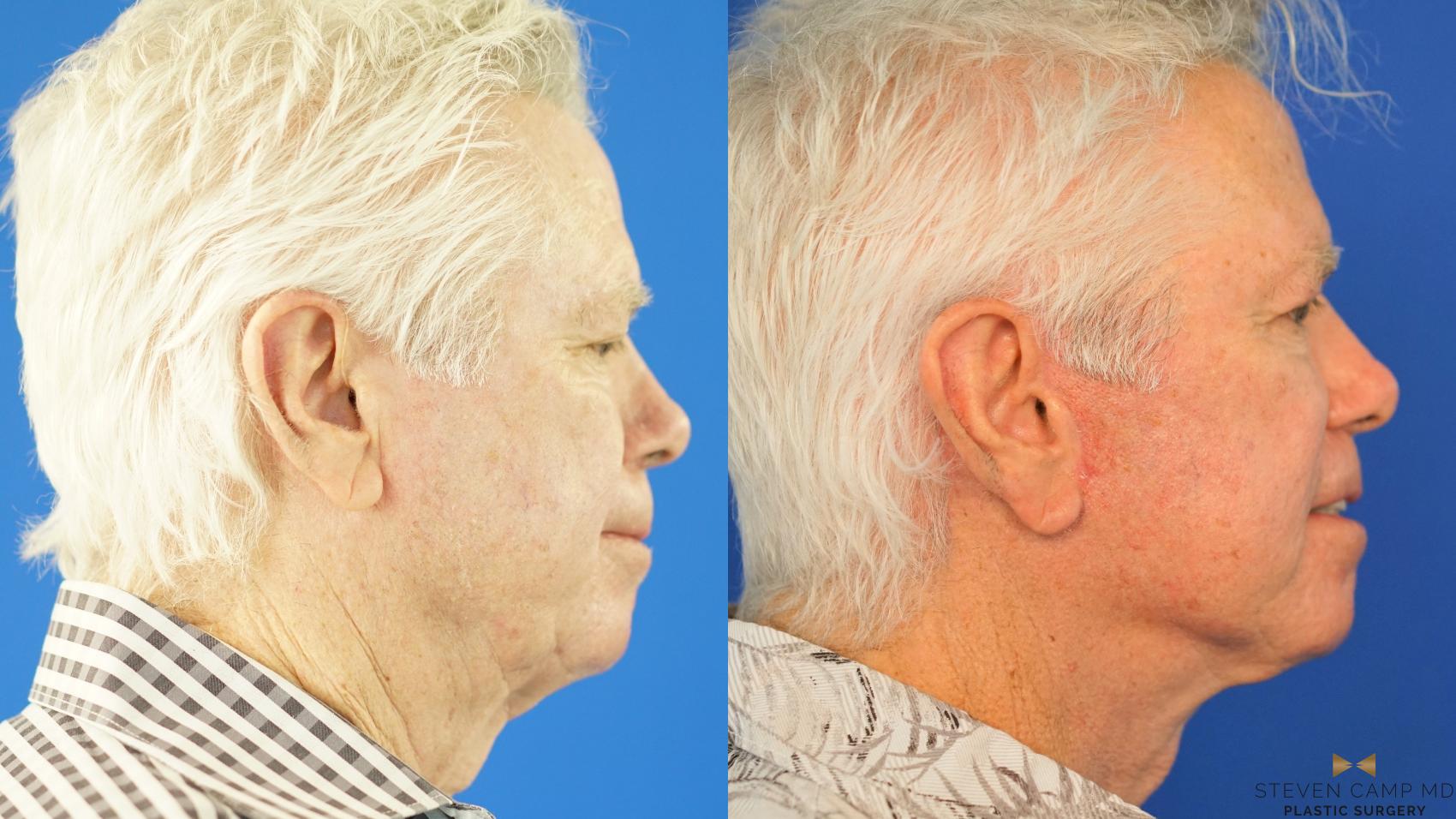 Before & After Facelift Case 339 Right Side View in Fort Worth, Texas