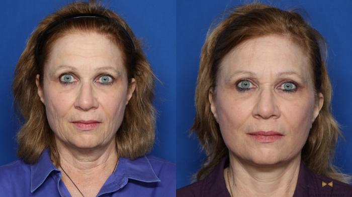Before & After Facelift Case 416 Front View in Fort Worth & Arlington, Texas