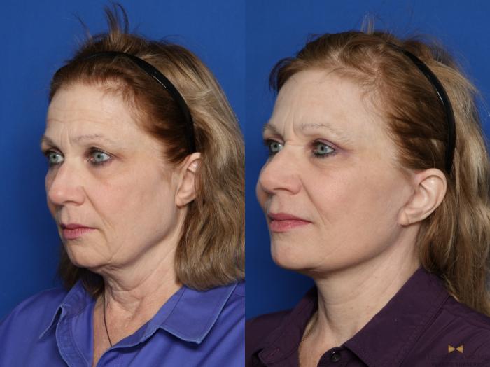 Before & After Necklift Case 416 Left Oblique View in Fort Worth & Arlington, Texas