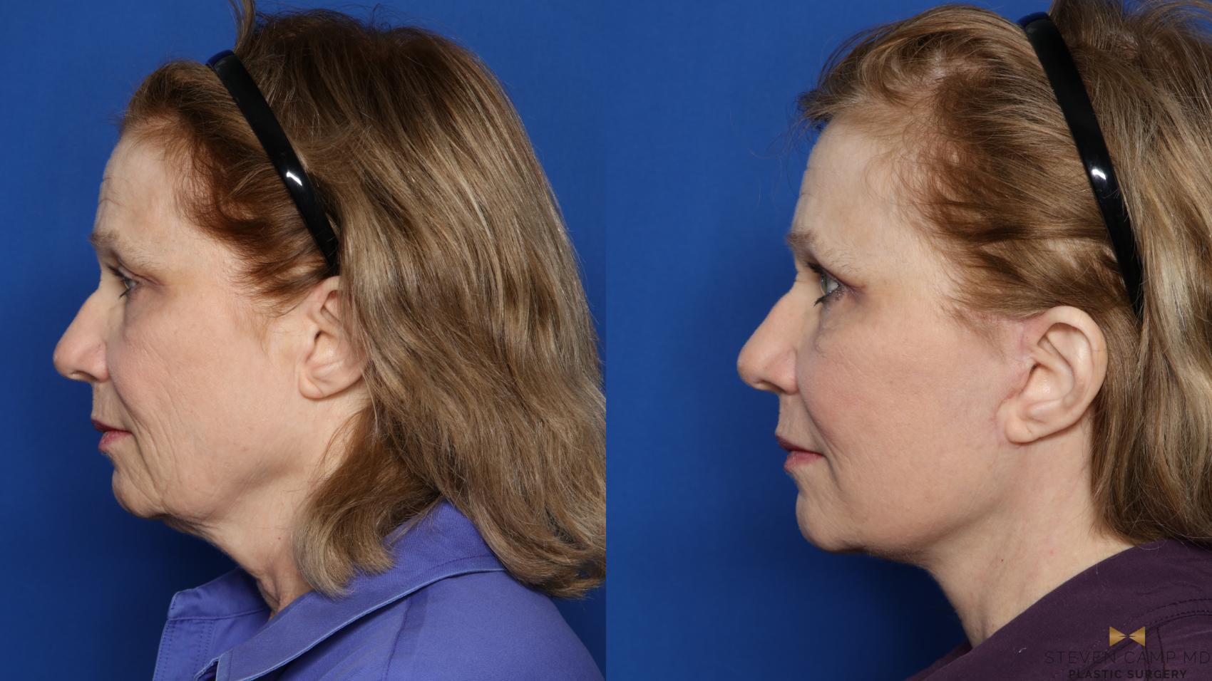 Before & After Necklift Case 416 Left Side View in Fort Worth & Arlington, Texas