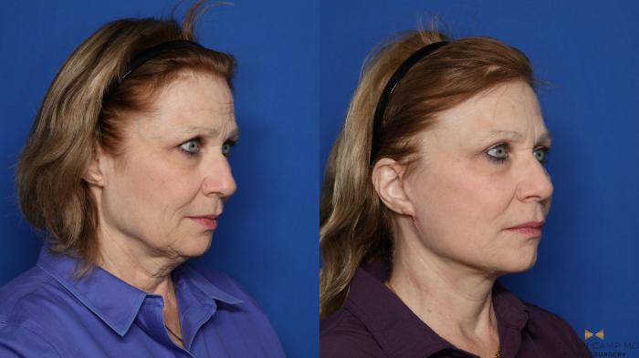 Before & After Blepharoplasty Case 416 Right Oblique View in Fort Worth & Arlington, Texas