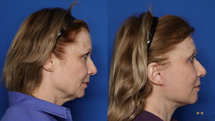 Before & After Facelift Case 416 Right Side View in Fort Worth & Arlington, Texas