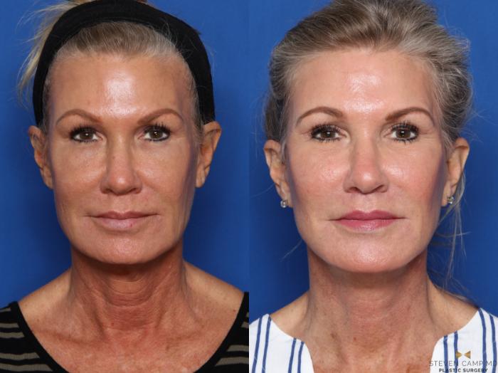 Before & After Necklift Case 469 Front View in Fort Worth & Arlington, Texas