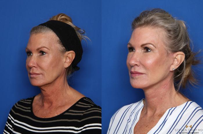 Before & After Facelift Case 469 Left Oblique View in Fort Worth & Arlington, Texas