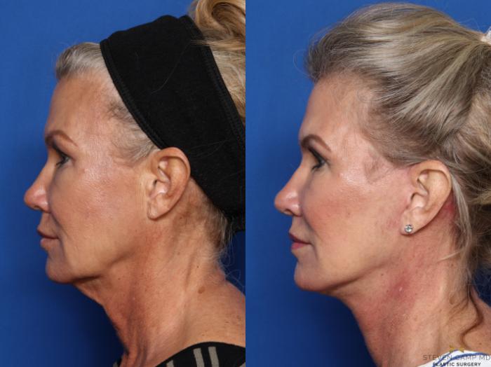Before & After Facelift Case 469 Left Side View in Fort Worth, Texas